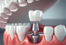 Achieving Optimal Oral Aesthetics Through Cutting-Edge Dental Implant Techniques